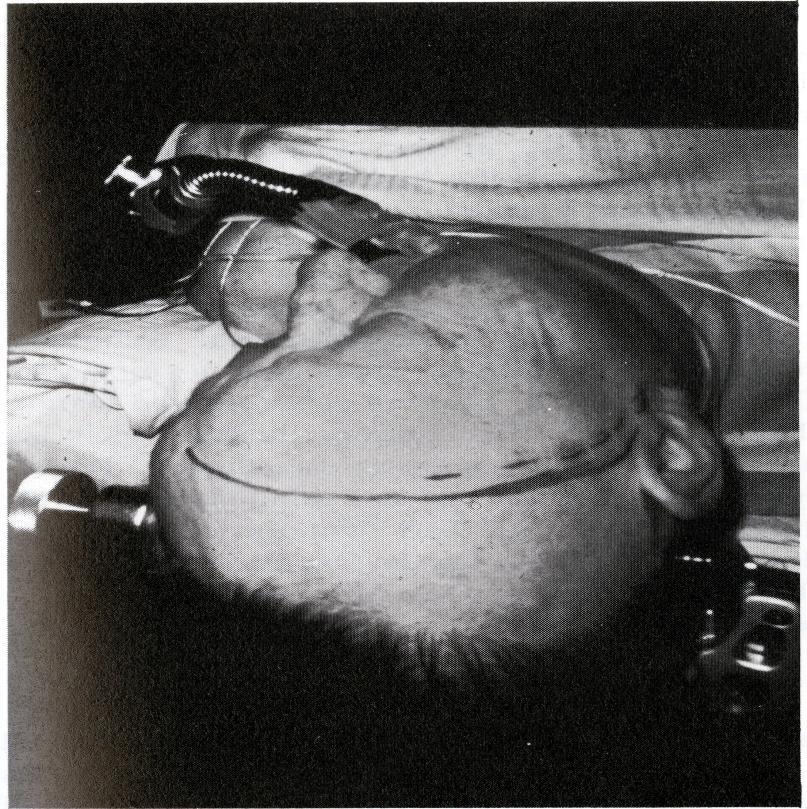 Figure 4. Patient positioned in Mayfield headrest. Solid line indicates incision line.