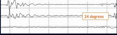 EEG during CPB Deep anesthesia Tall wide waves, mix of slow and fast frequency 36 degrees Early hypothermia