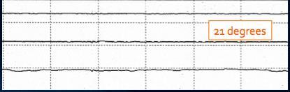 EEG during CPB Deep Hypothermia No EEG Activity Maximal reduction in CMRO2 Near