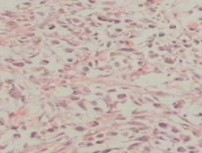 Figure 1: Section from thyroid showing variable sized follicles filled with colloid in case of colloid goiter (hematoxylin and eosin, X40).