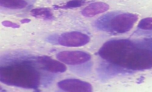 patients with benign cytological findings but having strong clinical suspicion of neoplasm should have either close clinical follow- up or histopathological examination so as to avoid false negative
