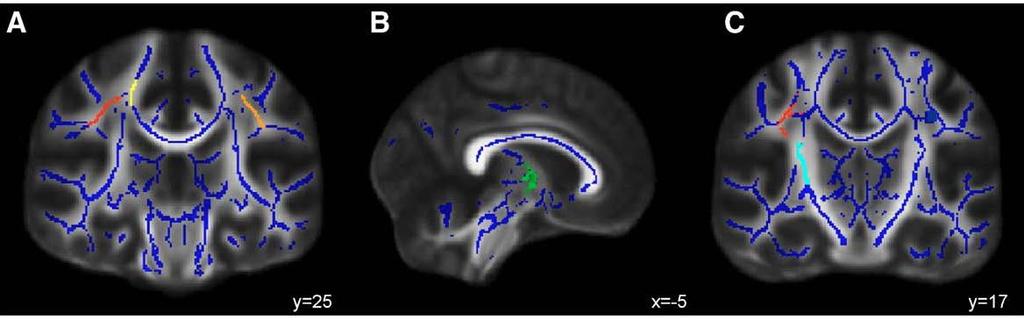 Bava, Thayer, Jacobus, Ward, Jernigan, & Tapert, 2010, Brain Research 9 White Matter Change Right Frontal- Parietal +11% Frontal +8%