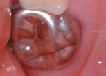 Figure 1a: A moderately hypoplastic, hypomineralized maxillary right permanent first molar in a 6-year-old child. Caries has formed in the occlusal pit.