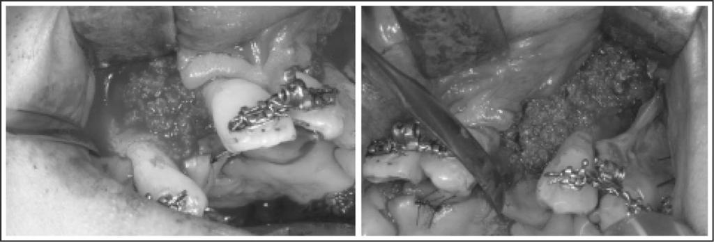 TWIN-TRACK DISTRACTION 167 FIGURE 3. Autogenous bone graft is inserted bilaterally into the cleft spaces.