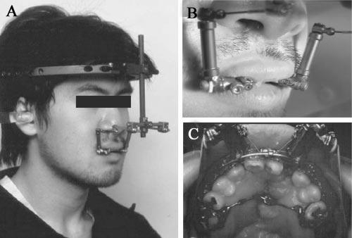 Surgical procedure A three-piece (bilateral cleft) type transverse Le Fort I maxillary osteotomy and simultaneous alveolar bone graft were performed under general anesthesia with oro-tracheal