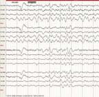 Reliable Markers of Poor Outcome: Myoclonic Seizures Myoclonic status epilepticus Bilateral rhythmic synchronous