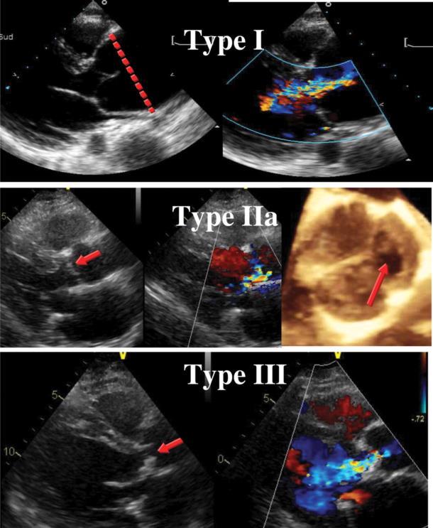 AR, Echocardiogram In patients with AR, careful aortic valve analysis is mandatory. The echo report should include information about the aetiology, the lesion process, and the type of dysfunction.
