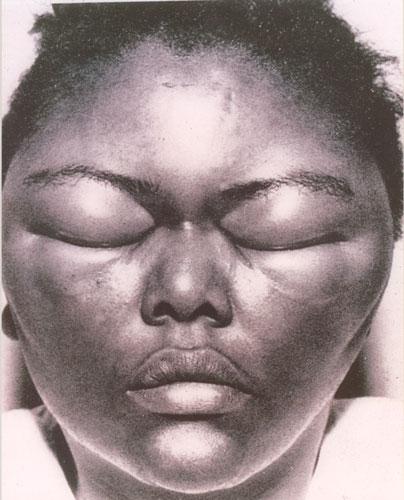 Hereditary Angioneurotic Edema is Due to Deficiency in C1INH* *Angioneurotic edema can also be acquired in in the course of certain diseases.