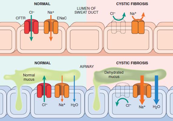Mendelian Disorders Cystic Fibrosis A chloride channel defect in the sweat duct causes increased chloride and sodium concentration in sweat.