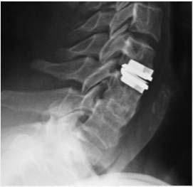 Spinal Disord Tech, 2007 MRI