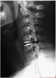 Study Conclusions: Patients with pre-op kyphosis or lordosis did not demonstrate any