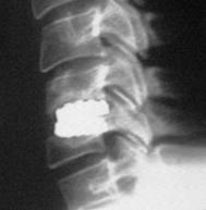 Bone Quality Device subsidence attributed to poor bone quality May result in kyphosis Kibuule, Seminars Spine Surg, 2009 Implant Considerations Multi-level TDR Keeled devices May merit extra