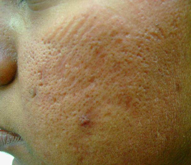 7,9 Thus after dermaroller treatment, skin barrier function remains undisturbed.