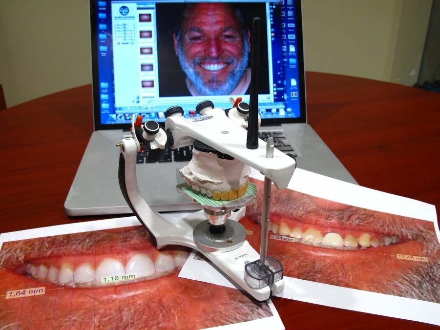 Those indicators are then transmitted to the lab as a guideline to the technician in the manual wax up of the future smile on a physical articulator using GPS Connect 2D to 3D digital face-bow
