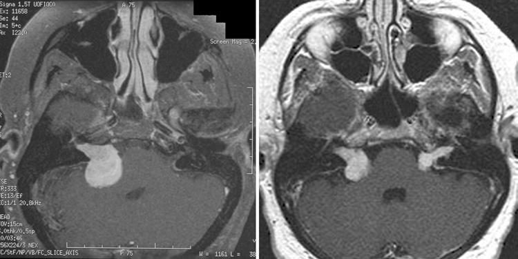 Regression of VS after excision of contralateral tumor Fig. 4. Case 2. Gadolinium-enhanced T1-weighted MR images demonstrating spontaneous right VS regression.
