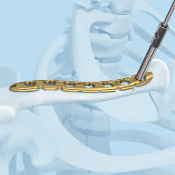 Screw Insertion 2b Fixation with 3.5 mm locking screws Note: If a locking screw will be used as the first screw, be sure that the fracture is reduced and the plate is held securely to the bone.