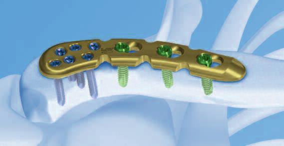 clavicle. Features and Benefits LCP Superior Clavicle Plate with lateral extension Shaft holes 3.
