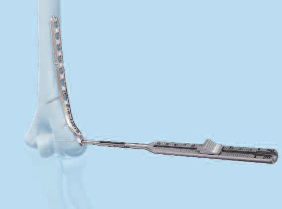 Insert Distal Screws in Lateral-Column Plate Insert screw at nominal angle Insert the VA-LCP drill sleeve 2.