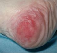Category of Pressure Ulcers Category II: Partial Thickness Skin Loss Category I: Non-blanchable Erythema Partial thickness loss of dermis presenting as a shallow open ulcer with a red pink wound bed,
