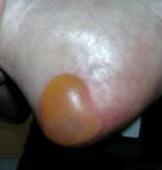 Darkly pigmented skin may not have visible blanching; its colour may differ from the surrounding area. Presents as a shiny or dry shallow ulcer without slough or bruising.