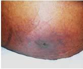 1 in Darkly Pigmented Skin Stage 1 Pressure Injury Example Intact skin with a localized area of non-blanchable erythema, which may appear
