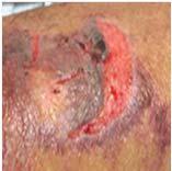 The wound bed is viable, pink or red, moist, and may also present as an intact or ruptured serum-filled blister.