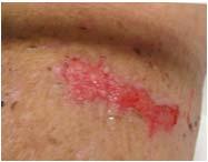 Characteristics of Viable Dermis Appearance Shiny, red Visible blood vessels in reticular layer