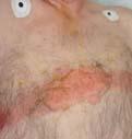 org Paraplegic with thickened skin due to slide transfers creates a visible edge to the ischial
