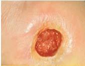 Stage 3 Pressure Injury Wound Bed Ulcer Surface Appearance Full