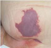 Discoloration may appear differently in darkly pigmented skin.