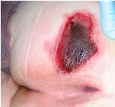 The wound may evolve rapidly to reveal the actual extent of tissue injury, or may