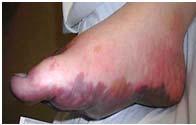 skin this pressure as a Deep Tissue Pressure Injury Day 3 - Classify discolored