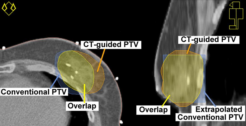 The shift towards CT guided breast radiotherapy Figure 2.