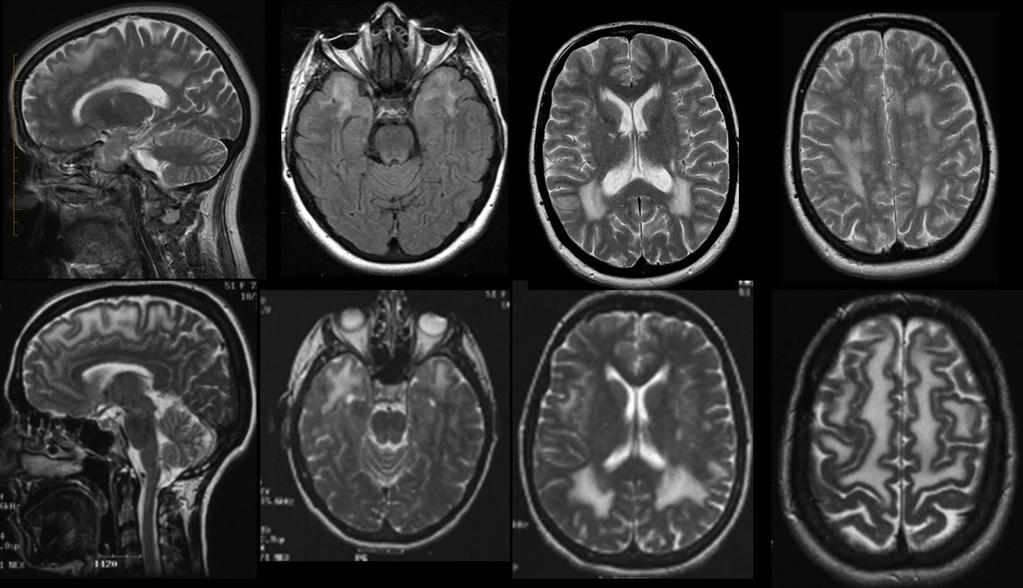 Methods Participants We have already identified 25 cases with undiagnosed leukoencephalopathy among the patients either evaluated at the Department of Neuroradiology of the Montreal Neurological