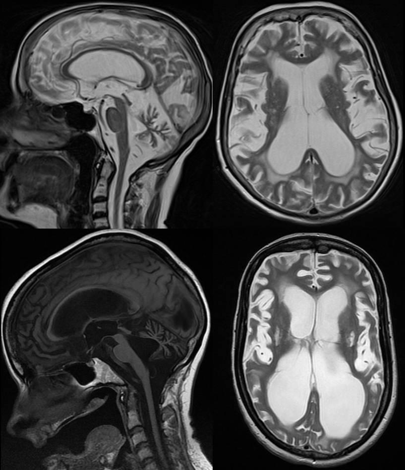 Figure 3: sagittal and axial T2-weighted images of a 63 year old woman (top) and sagittal T1- and axial T2- weighted images of her 41 year old daughter.