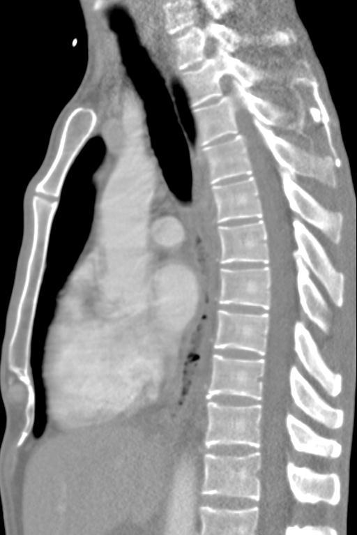THE ESOPHAGUS Hiatal hernia Mural thickening of distal esophagus