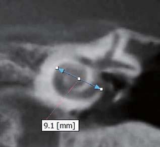 Using a high resolution cone beam CT, a line passing from the round