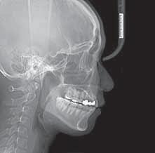 Skull : PA - Maxillary sinus Skull :