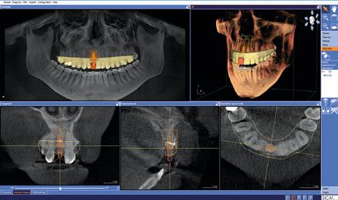 DIAGNOSTICS AND PLANNING. Enjoy intuitive software navigation through all views, including a unique findings tool. Position your implant based on virtual prosthetics. FULL TRANSPARENCY.