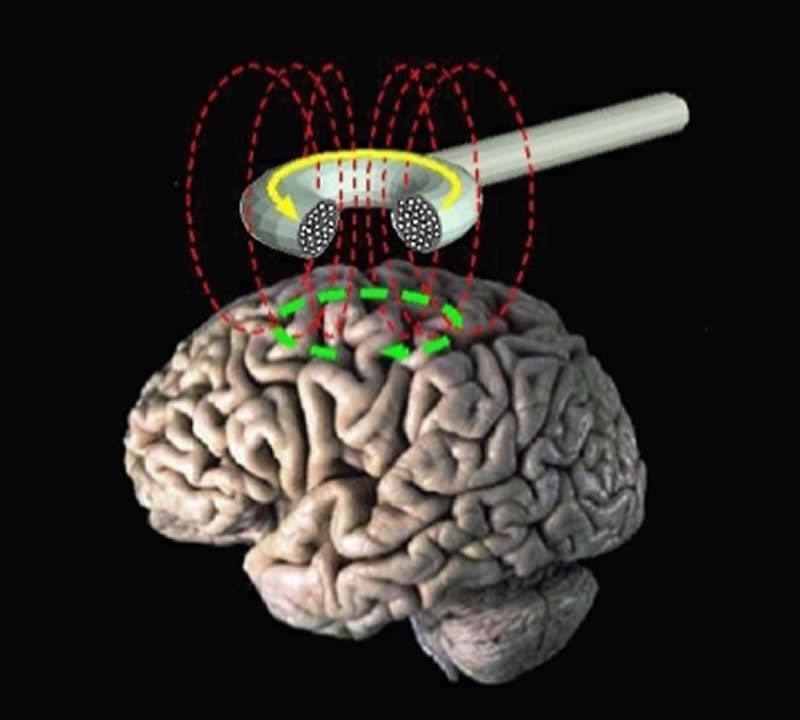 TMS Hyperexcitability: an epileptic Trait Paired