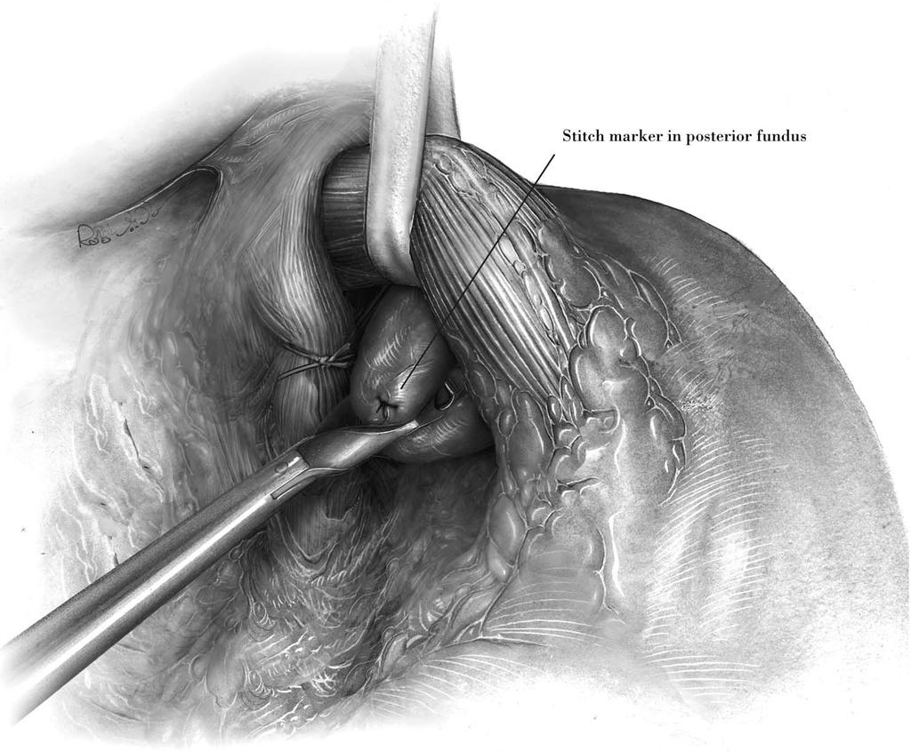 124 MAISH AND HAGEN 10 Delivery of the fundus behind the esophagus. The Babcock clamp in the left lower retracting port is repositioned on the Penrose drain, and the esophagus is lifted anteriorly.