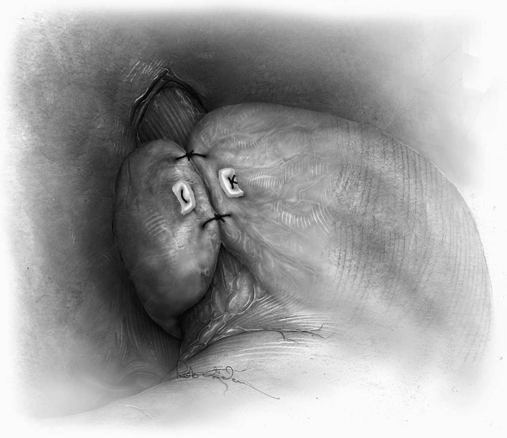 126 MAISH AND HAGEN 12 Suturing the fundoplication. A 60-French Bougie is passed under direct visualization to properly size the fundoplication.