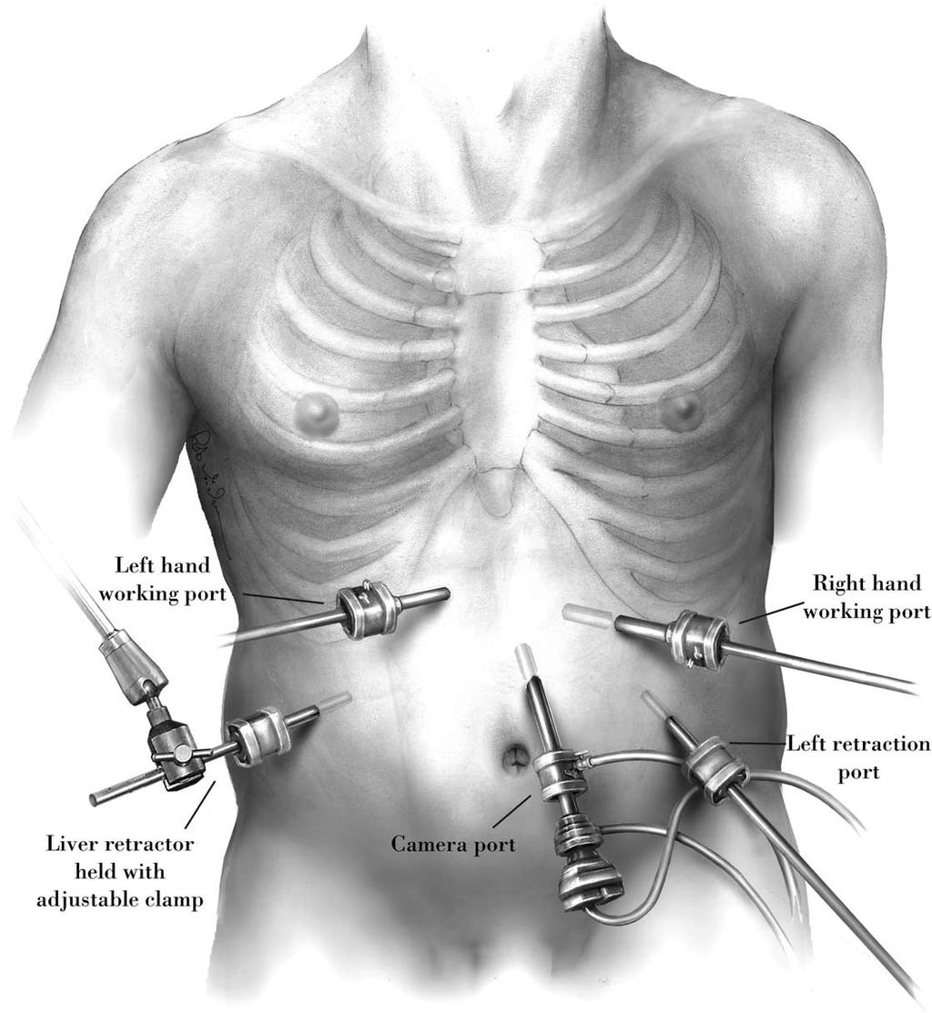 116 MAISH AND HAGEN movement of instruments in the lower abdominal ports will be hindered.