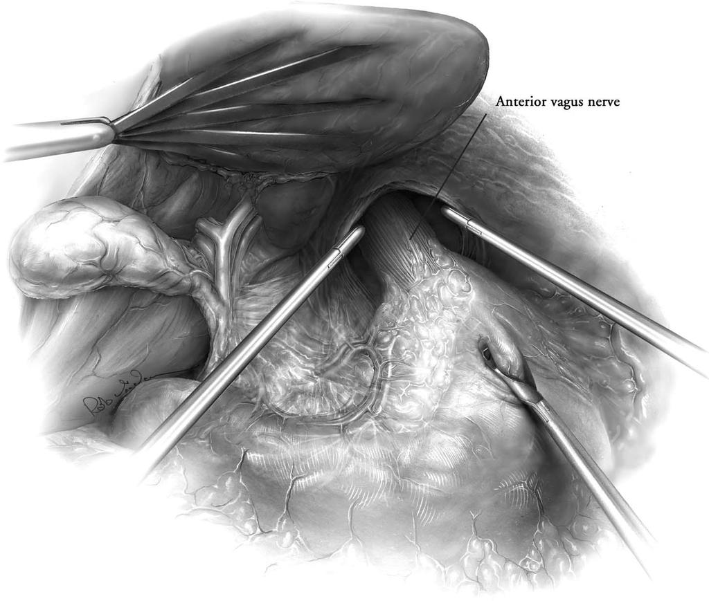 118 MAISH AND HAGEN 3 Identification of the anterior vagus nerve. The incision in the peritoneum over the right crus is continued across the anterior aspect of the hiatus.