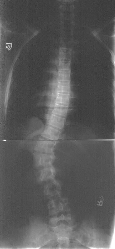 Scoliosis FIGURE 5. Posteroanterior radiograph of the spine in a patient with a double spinal curve.