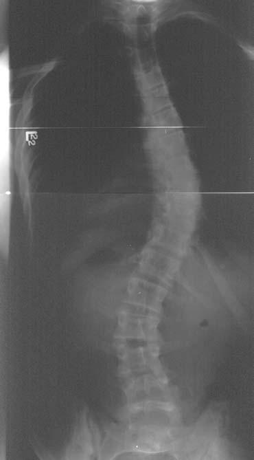 Posteroanterior radiograph of the spine in a patient with a thoracolumbar spinal curve.