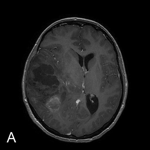 Fig.2.2. Internal capsule displacement in a 34-year-old woman with newly diagnosed anaplastic oligoastrocytoma.