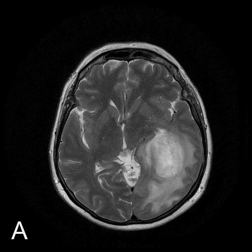 Fig.2.3. Inferior frontooccipital fasciculus disruption in a 63-year-old woman with newly diagnosed glioblastoma A.