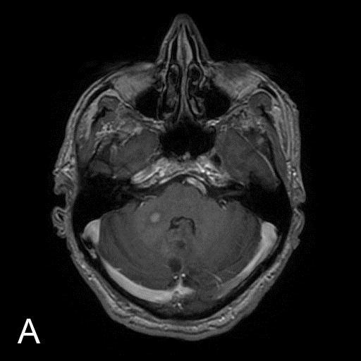 Fig.2.4. Right middle cerebellar peduncle fibers infiltration in a 62-year-old man due to residual glioblastoma tissues 2 weeks after tumor resection from the posterior cranial fossa. A.
