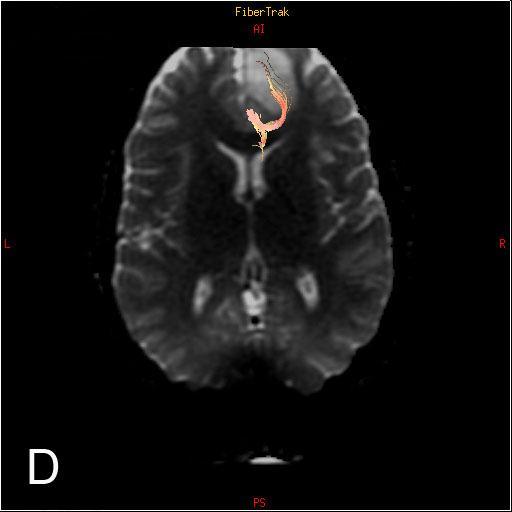 Fig.2.5. Subcortical U-fibers edema in a 25-year-old woman with newly diagnosed anaplastic oligoastrocytoma. A. Axial T2 image shows a hyperintense mass in the right frontal lobe. B.